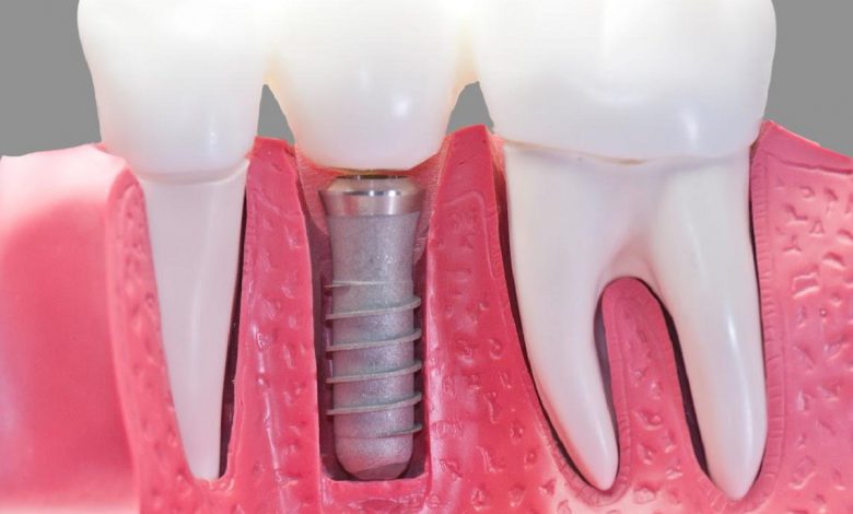 5 أسباب قد تؤدي لسقوط أسنانك في عمر مبكّر