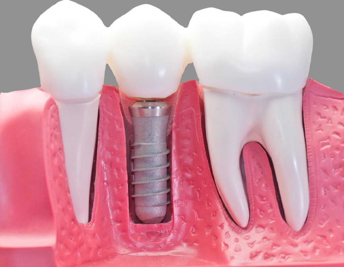 5 أسباب قد تؤدي لسقوط أسنانك في عمر مبكّر